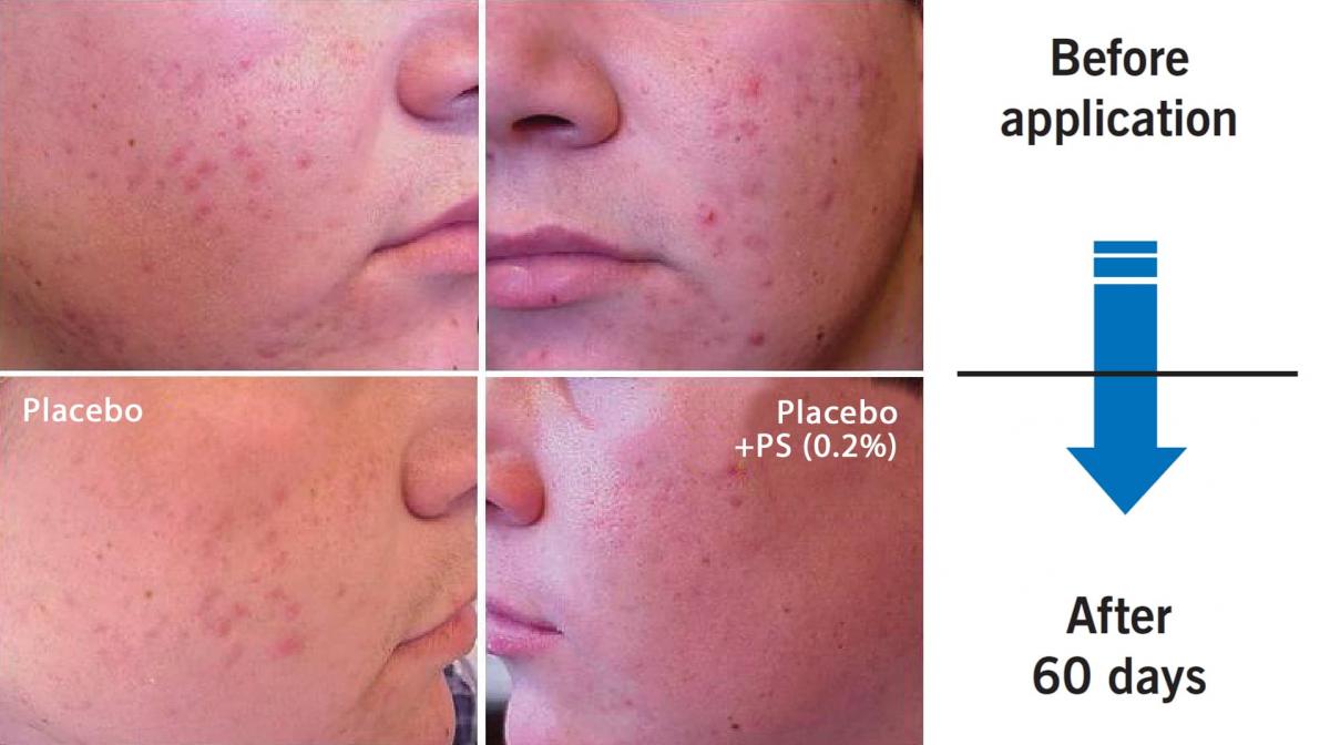 phytosphingosine-acne-before-after.jpg